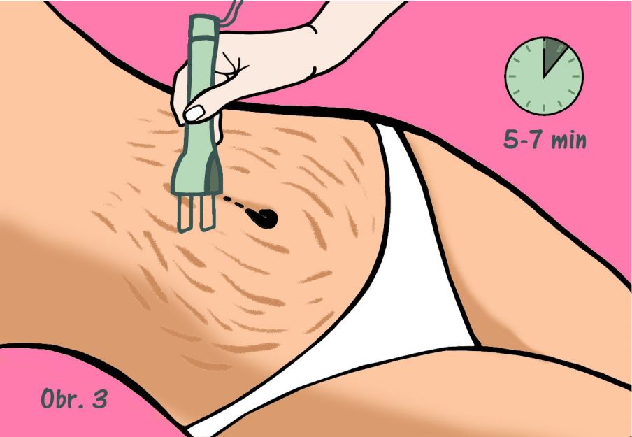 Ako sa zbaviť strií - žene aplikujú na brucho laserovú terapiu
